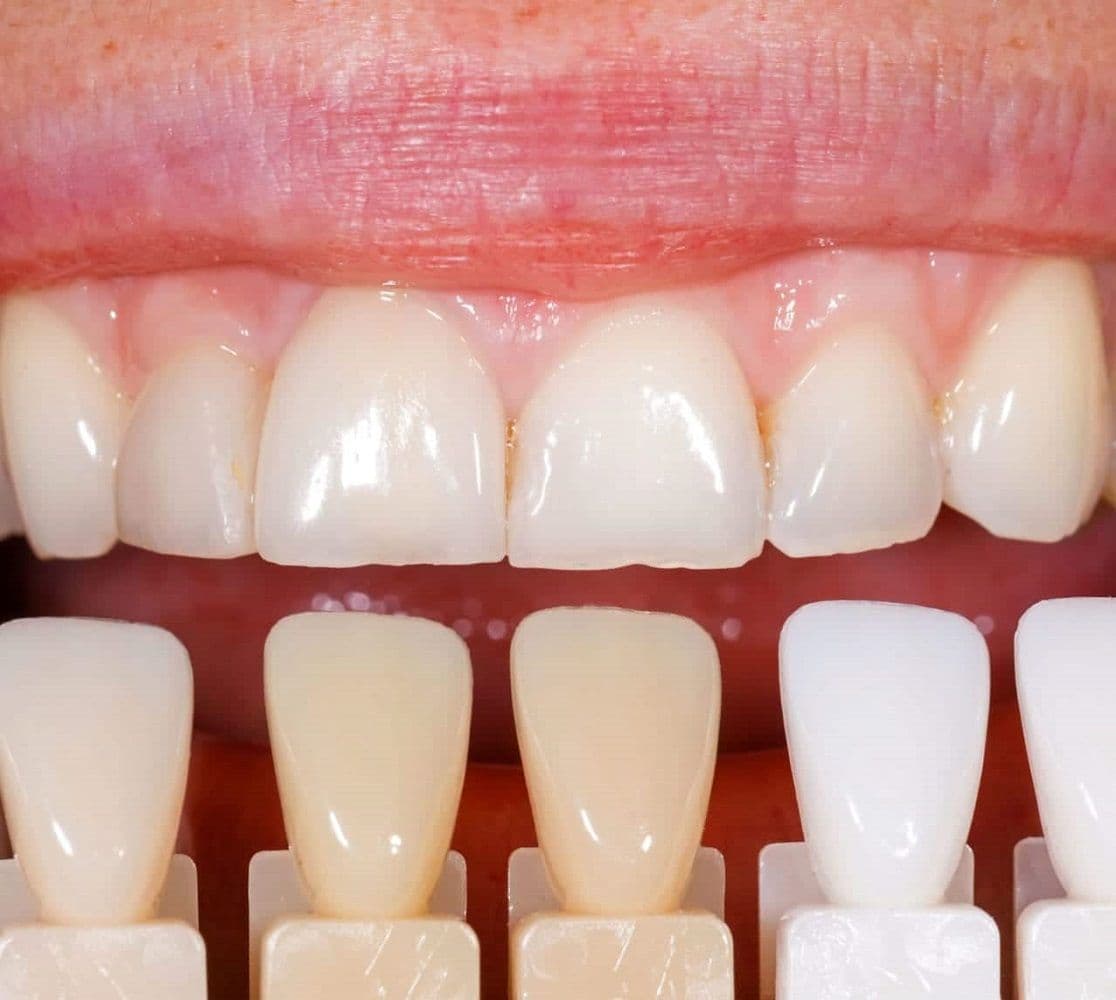 Tooth Color Restoration