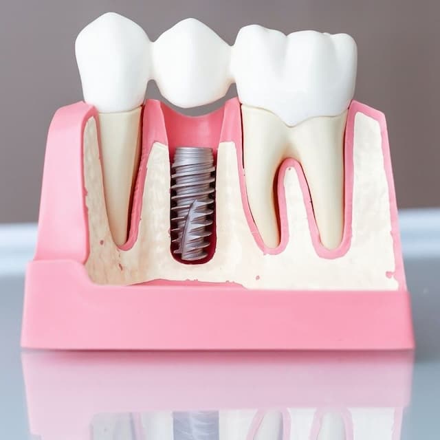 Dental Implants