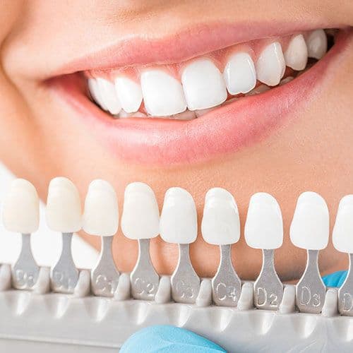 Dental Veneers Treatment