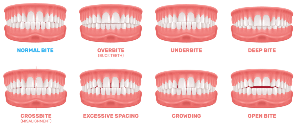 Aligner Teeth