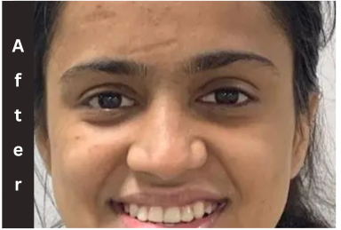 Best Orthodontist in Pune - Smile Transformation Result