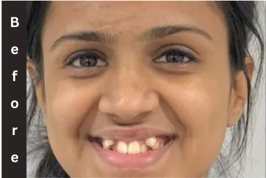 Orthodontist in Pune - Before and After Smile Correction